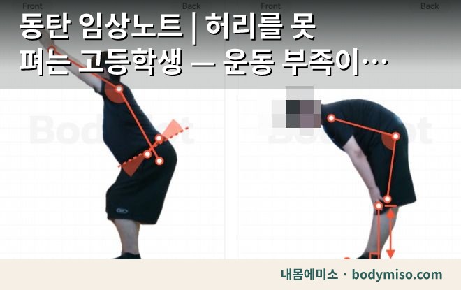 동탄 임상노트 | 허리를 못 펴는 고등학생 — 운동 부족이 만든 몸