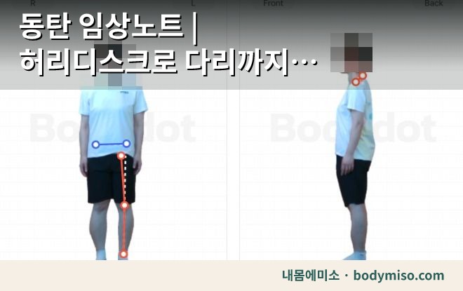 동탄 임상노트 | 허리디스크로 다리까지 저리다고 오신 분 — 첫 평가에서 본 것