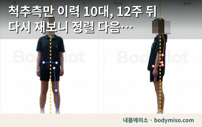 척추측만 이력 10대, 12주 뒤 다시 재보니 정렬 다음 과제가 보였습니다