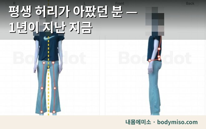 평생 허리가 아팠던 분 — 1년이 지난 지금